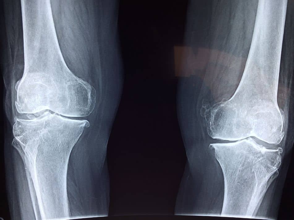 Zdjęcie RTG kości nóg
